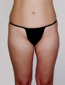Body Liposuction Before and After Pictures Greensboro, NC
