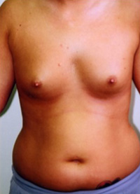 Breast Augmentation Before and After Pictures Greensboro, NC