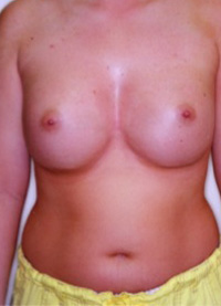 Breast Augmentation Before and After Pictures Greensboro, NC