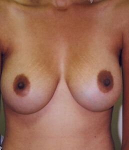 Breast Augmentation Before and After Pictures Greensboro, NC