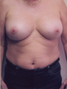 Breast Augmentation Before and After Pictures Greensboro, NC