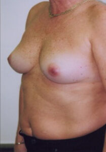 Breast Augmentation Before and After Pictures Greensboro, NC