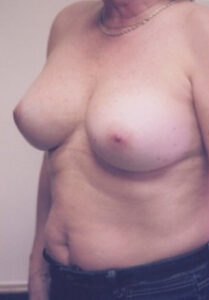 Breast Augmentation Before and After Pictures Greensboro, NC