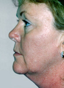 Facelift Before and After Pictures Greensboro, NC