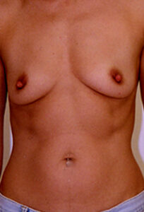 Breast Augmentation Before and After Pictures Greensboro, NC