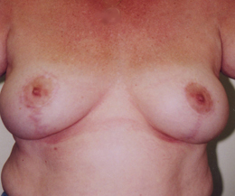 Breast Lift Before and After Pictures Greensboro, NC